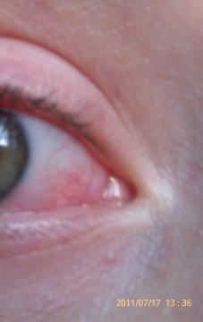 Červené oko Červené oko